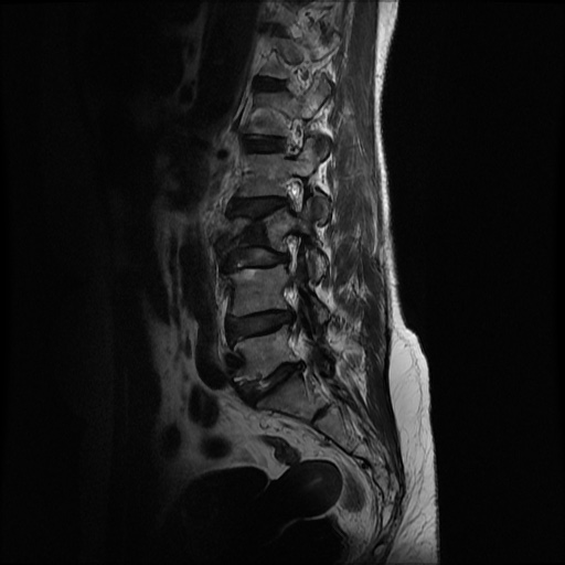 File:Burst fracture - lumbar spine (Radiopaedia 72877-83541 Sagittal T2 8).jpg