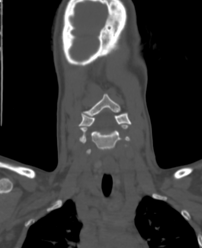 File:Butterfly vertebra (Radiopaedia 77903-90209 Coronal bone window 4).jpg