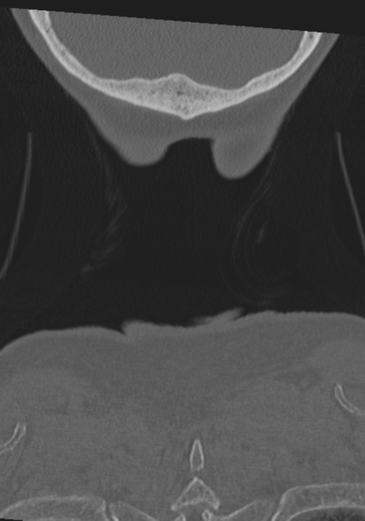 C2 fracture with vertebral artery dissection (Radiopaedia 37378-39199 Coronal bone window 66).png