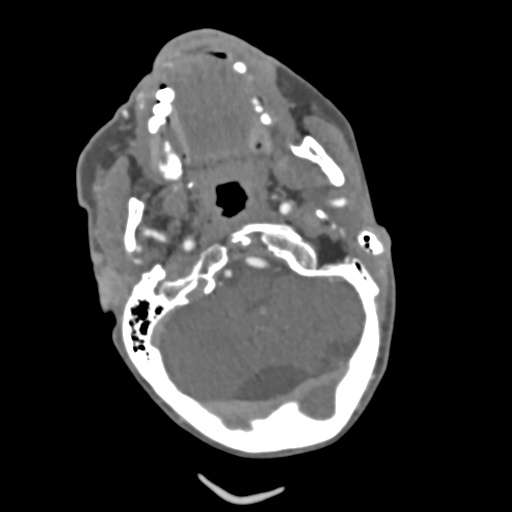 File:C2 fracture with vertebral artery dissection (Radiopaedia 37378-39200 A 189).png