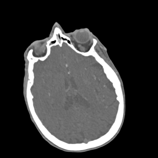 File:C2 fracture with vertebral artery dissection (Radiopaedia 37378-39200 A 256).png