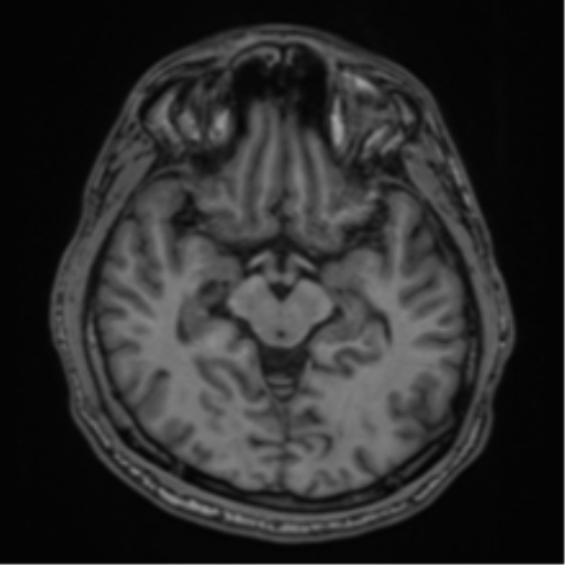 CNS vasculitis (Radiopaedia 55715-62263 Axial T1 15).png