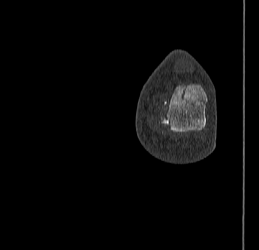 Calcaneal fracture - Sanders type 4 (Radiopaedia 90179-107370 Coronal bone window 87).jpg