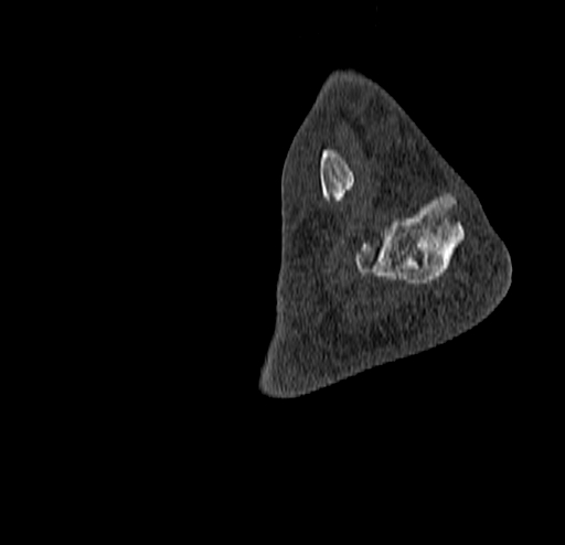 Calcaneal fracture - Sanders type 4 (Radiopaedia 90179-107370 Sagittal bone window 76).jpg