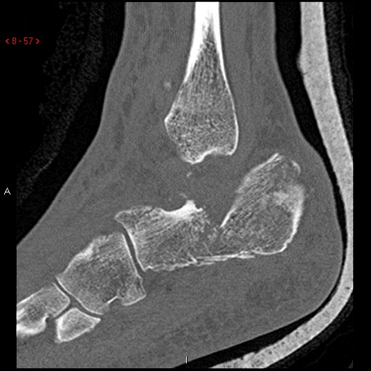 File:Calcaneal fracture and associated spinal injury (Radiopaedia 17896-17656 Sagittal bone window 7).jpg