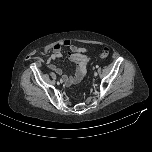 Calcified adrenal glands and Spigelian hernia (Radiopaedia 49741-54988 A 190).jpg