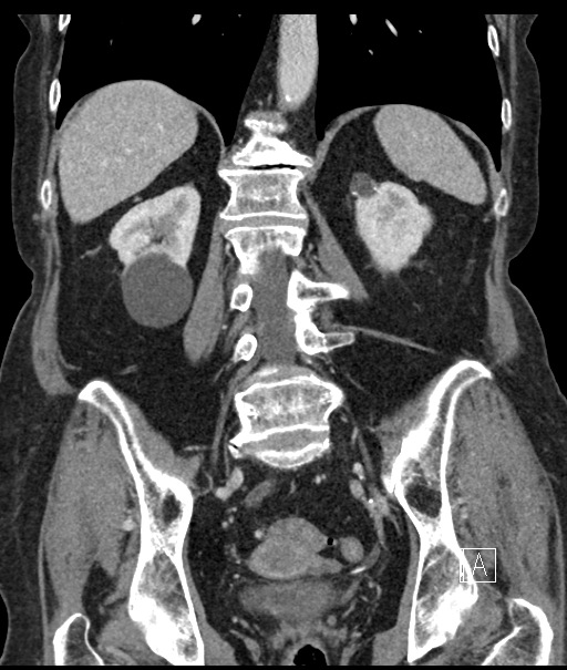 Calcified adrenal glands and Spigelian hernia (Radiopaedia 49741-54988 B 78).jpg
