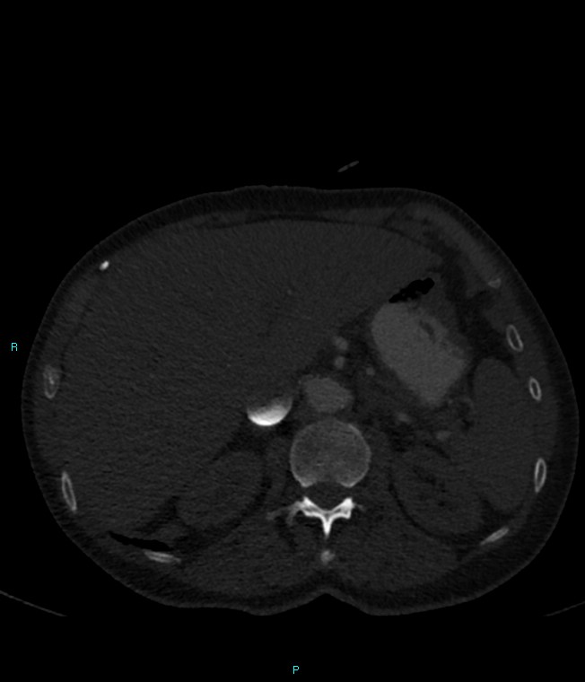 Calcified cerebral emboli from left ventricular thrombus (Radiopaedia 84420-99760 Axial bone window 86).jpg