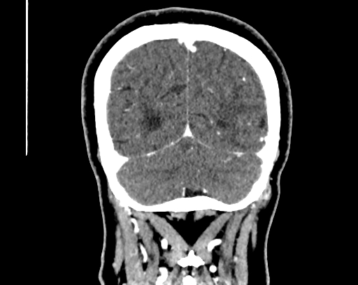 Calcified cerebral hydatid cyst (Radiopaedia 65603-74717 C 62).jpg