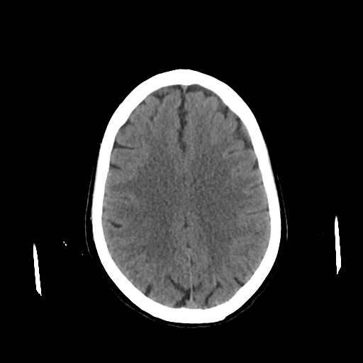 File:Calcified meningioma - cervical canal (Radiopaedia 70136-80171 Axial non-contrast 18).jpg