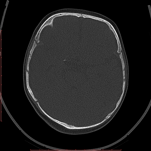 Calcified middle cerebral artery embolism (Radiopaedia 78949-91860 Axial bone window 20).jpg