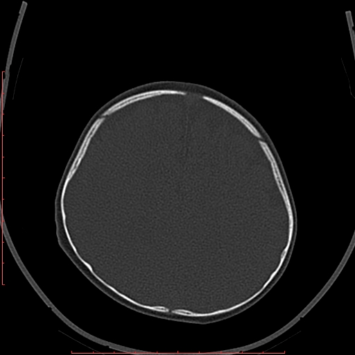 File:Calcified middle cerebral artery embolism (Radiopaedia 78949-91860 Axial bone window 56).jpg