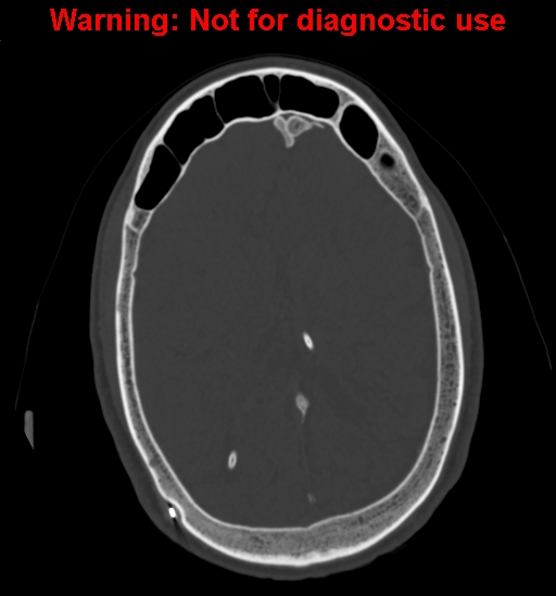 File:Calvarial thickening from chronic shunting (Radiopaedia 60079-67637 Axial bone window 112).jpg