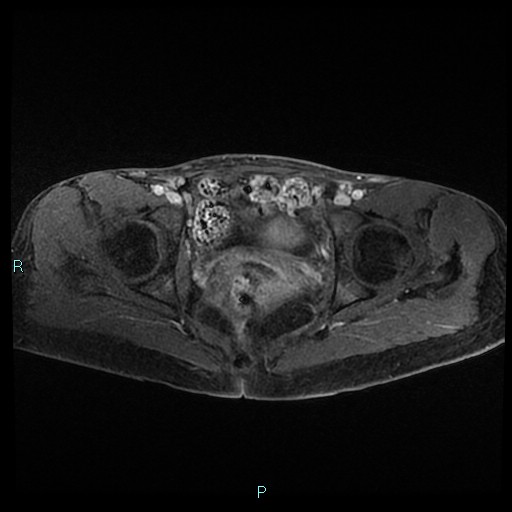 File:Canal of Nuck cyst (Radiopaedia 55074-61448 Axial T1 C+ fat sat 38).jpg