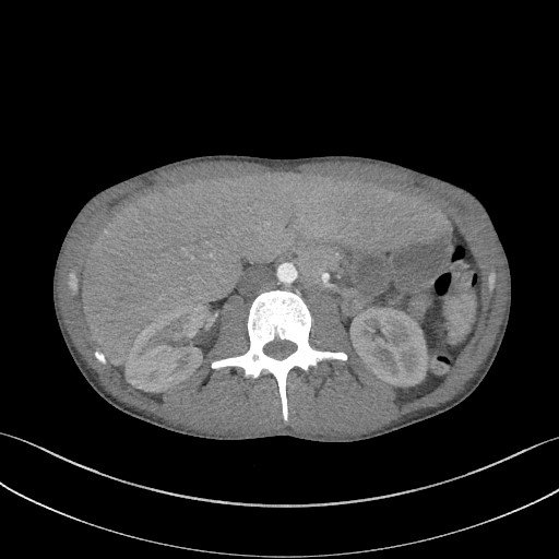 Cannonball metastases - testicular choriocarcinoma (Radiopaedia 84510-99891 B 123).jpg