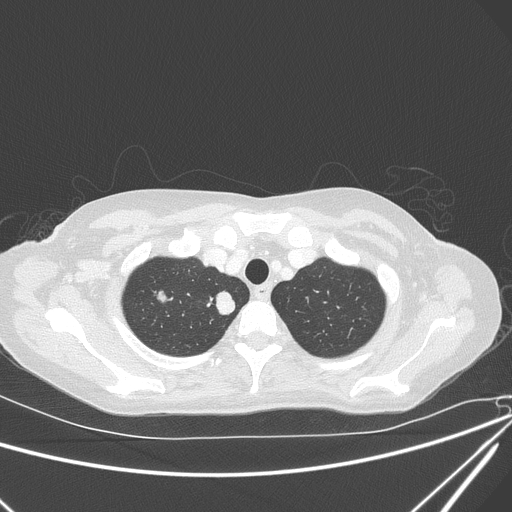 Canonball lung metastasis (Radiopaedia 77634-89837 Axial lung window 28).jpg