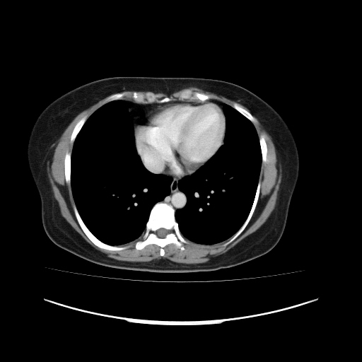 File:Carcinoma colon - hepatic flexure (Radiopaedia 19461-19493 A 8).jpg