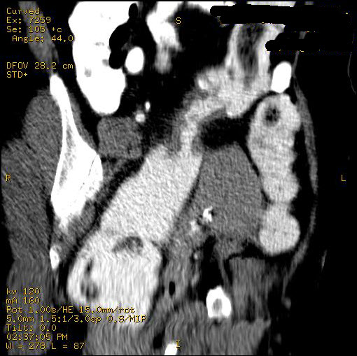 File:Carcinoma of sigmoid colon (Radiopaedia 23071-23100 D 2).jpg