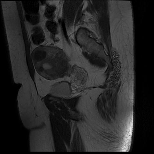 File:Carcinoma of the cervix (Radiopaedia 89018-105858 Sagittal T2 4).jpg