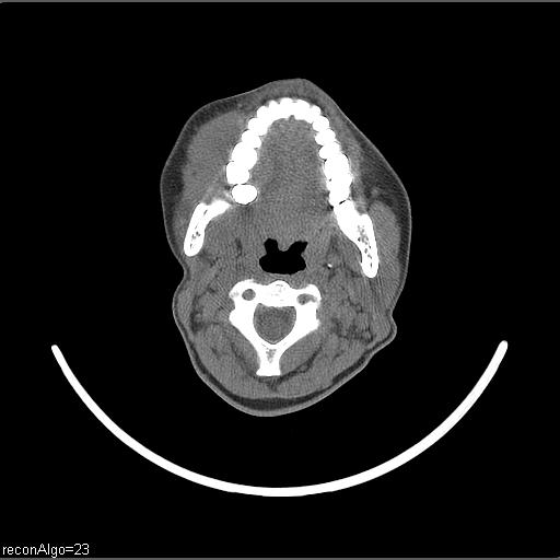 Carcinoma of the maxillary antrum (Radiopaedia 53805-59888 Axial non-contrast 46).jpg