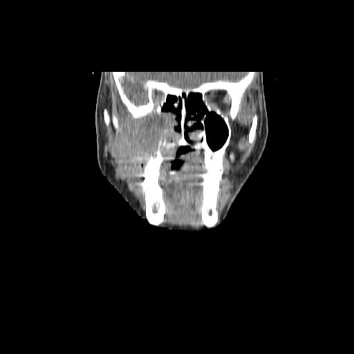 Carcinoma of the maxillary antrum (Radiopaedia 53805-59888 Coronal C+ delayed 44).jpg