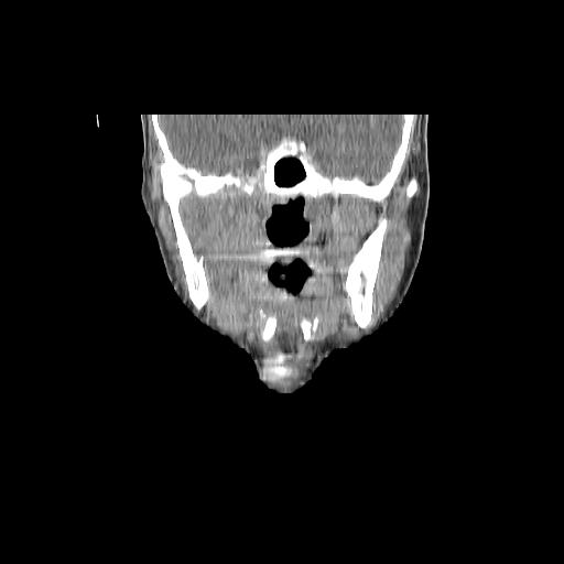 Carcinoma of the maxillary antrum (Radiopaedia 53805-59888 Coronal C+ delayed 76).jpg