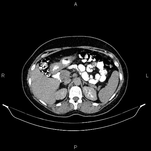 File:Carcinoma of uterine cervix (Radiopaedia 85861-101700 Axial C+ delayed 16).jpg