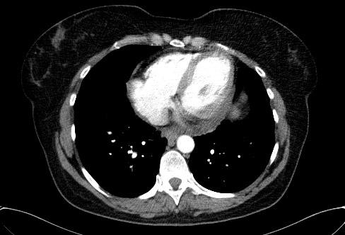 Cardiac sarcoidosis (Radiopaedia 74548-85534 A 62).jpg