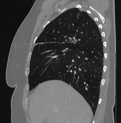 Cardiac sarcoidosis (Radiopaedia 74548-85534 Sagittal lung window 69).jpg