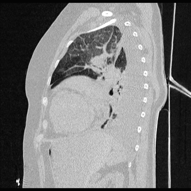Cardiogenic pulmonary edema (Radiopaedia 29213-29609 Sagittal lung window 68).jpg
