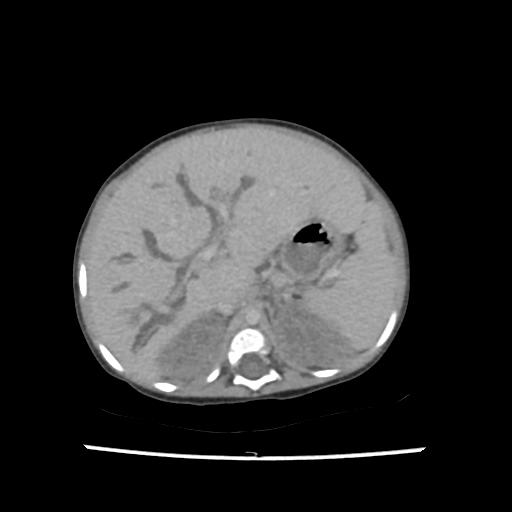 File:Caroli disease with autosomal recessive polycystic kidney disease (ARPKD) (Radiopaedia 89651-106703 B 58).jpg