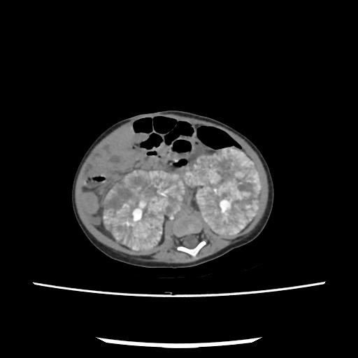 Caroli disease with autosomal recessive polycystic kidney disease (ARPKD) (Radiopaedia 89651-106703 E 138).jpg