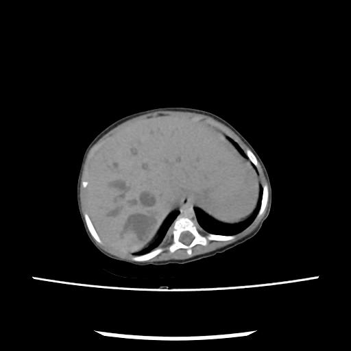 File:Caroli disease with autosomal recessive polycystic kidney disease (ARPKD) (Radiopaedia 89651-106703 E 34).jpg
