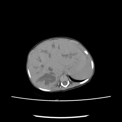 Caroli disease with autosomal recessive polycystic kidney disease (ARPKD) (Radiopaedia 89651-106703 E 41).jpg