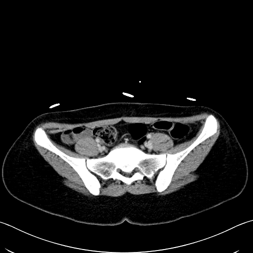 Caroli disease with medullary sponge kidney (Radiopaedia 82622-96804 C 56).jpg