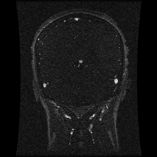 Carotid arterial dissection with acute cerebral infarction (Radiopaedia 26636-26784 MRV 70).jpg