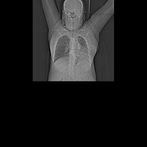 File:Carotid body tumor (Radiopaedia 21021-20948 A 2).jpg