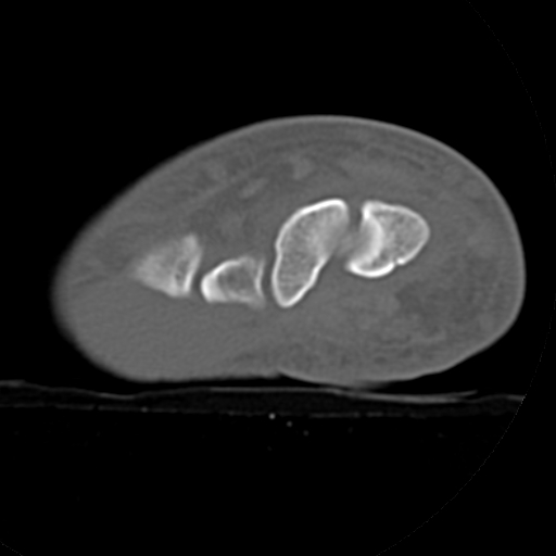File:Carpo-metacarpal fracture-dislocations with hamatum split fracture (Radiopaedia 18482-18343 Axial bone window 25).jpg
