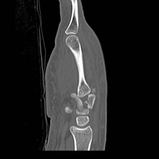 File:Carpo-metacarpal fracture-dislocations with hamatum split fracture (Radiopaedia 18482-18343 Sagittal bone window 8).jpg