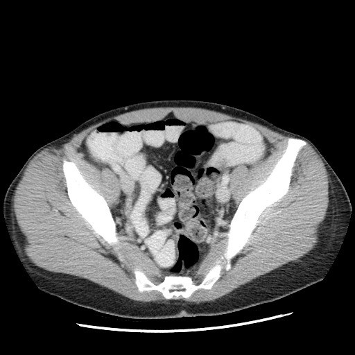 Castleman disease with fibrous pseudotumor in the abdomen (Radiopaedia 77296-89373 A 103).jpg