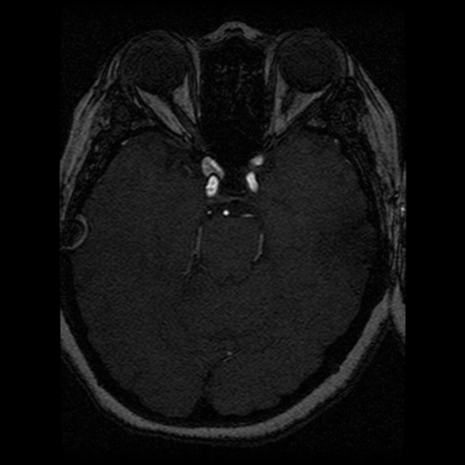 Cavernoma, DVA and right ICA aneurysm (Radiopaedia 33890-35072 E 57).png