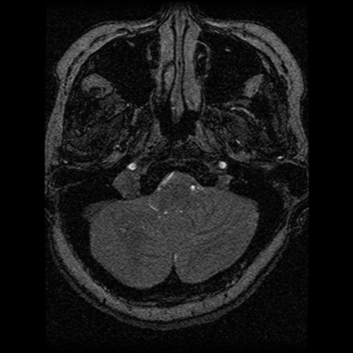 Cavernoma, DVA and right ICA aneurysm (Radiopaedia 33890-35072 E 98).png