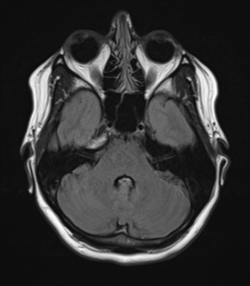 File:Cavernoma with bleed - midbrain (Radiopaedia 54546-60774 Axial FLAIR 9).png