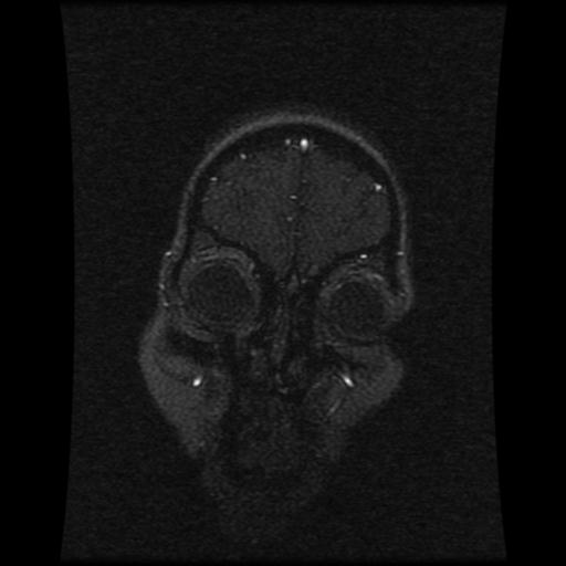 Cavernoma with developmental venous anomaly (Radiopaedia 22470-22507 MRV 112).jpg