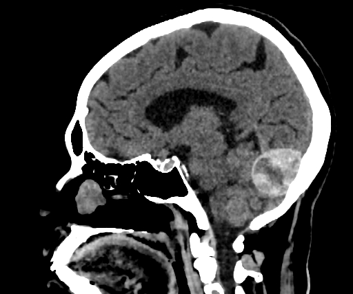 Cavernous hemangioma of the cerebellar falx (Radiopaedia 73025-83723 B 179).jpg