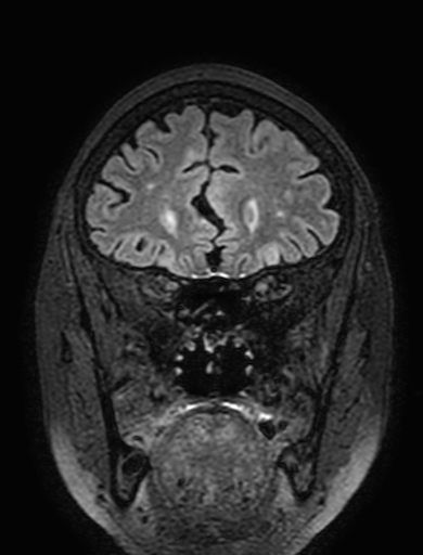 Cavernous hemangioma of the cerebellar falx (Radiopaedia 73025-83724 Coronal FLAIR 87).jpg