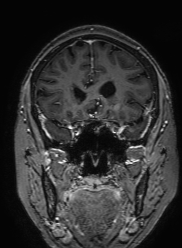 Cavernous hemangioma of the cerebellar falx (Radiopaedia 73025-83724 Coronal T1 C+ 122).jpg