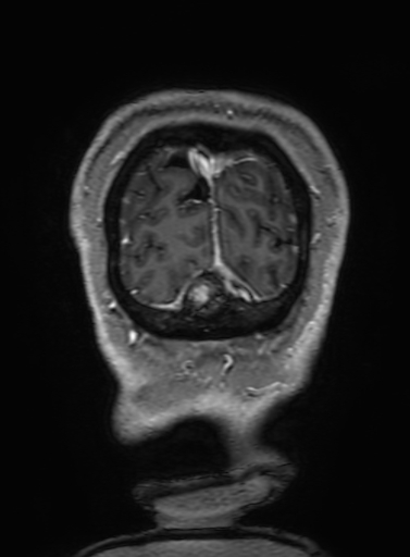 Cavernous hemangioma of the cerebellar falx (Radiopaedia 73025-83724 Coronal T1 C+ 353).jpg
