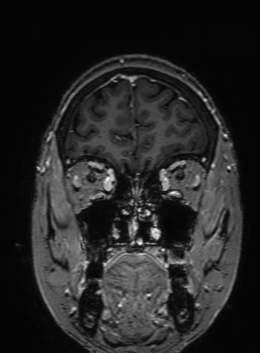 Cavernous hemangioma of the cerebellar falx (Radiopaedia 73025-83724 Coronal T1 C+ 75).jpg