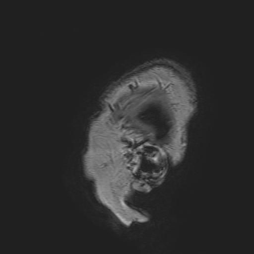 File:Cavernous hemangioma of the cerebellar falx (Radiopaedia 73025-83724 Sagittal T1 5).jpg